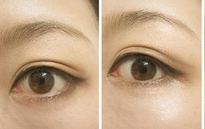 沈燕華醫(yī)生雙眼皮技術(shù)值得信賴，術(shù)后效果受到患者一致好評！