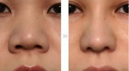 哪位醫(yī)生在全國范圍內(nèi)的脂肪填充領域技術比較好？