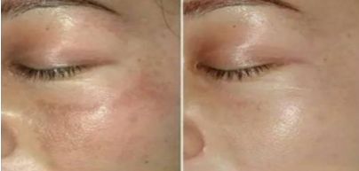 中國(guó)醫(yī)院雙眼皮修復(fù)技術(shù)，2023新晉熱門曝光！