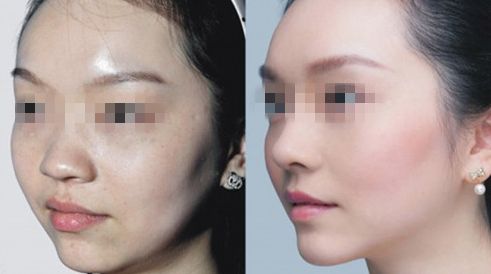 臺州哪家醫(yī)院治療乳頭矯正效果好？