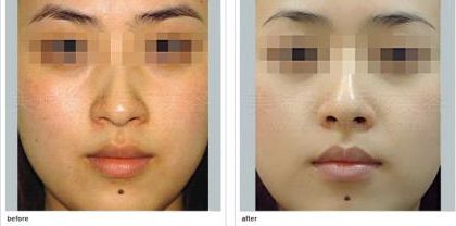 臺州狐臭治療中哪家醫(yī)院效果好？