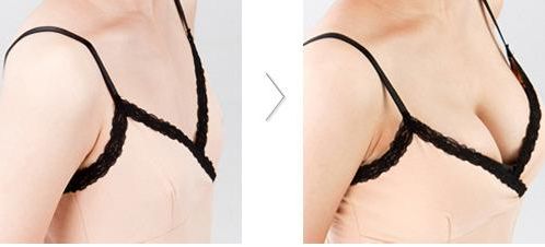 三明市第二醫(yī)院重磅推薦：陳國章醫(yī)生絕佳雙眼皮+內(nèi)眼角完美案例！