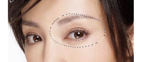 西安哪家醫(yī)院治療上瞼下垂價格合適？名醫(yī)推薦+費用咨詢