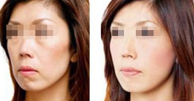 果酸祛痘間隔多久做一次？效果不明顯怎么辦？