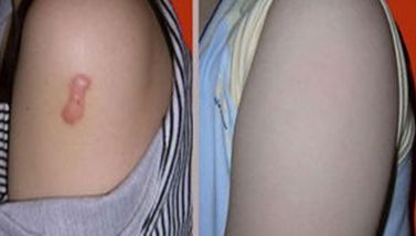 廣州天姿整形醫(yī)院，鼻部整形效果曝光，看看這次個案如何！