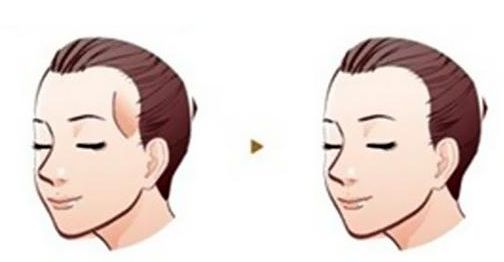 癌癥患者的雙眼皮手術(shù)費(fèi)用分析及成功案例分享