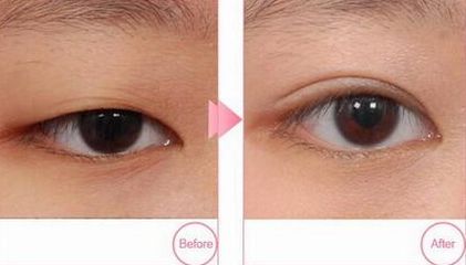 青島市立醫(yī)院雙眼皮割哪位醫(yī)生技術精湛？附案例和價格表參考