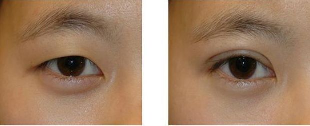 秦永平醫(yī)生雙眼皮手術(shù)效果如何？?jī)?yōu)美案例圖賞