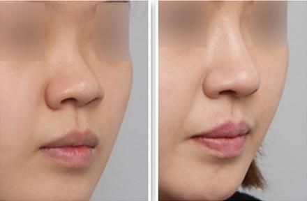 運(yùn)城市頂級(jí)整容醫(yī)院榜單公布！引領(lǐng)鼻部整形新潮流