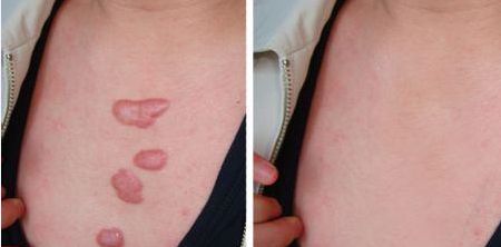 【重慶軍醫(yī)大學(xué)胡金香割雙眼皮效果如何？專(zhuān)家案例揭秘！】