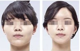 前額中部提眉術(shù)效果評(píng)測(cè)