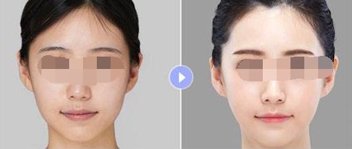 廣州哪家隆胸整形醫(yī)院好？排名大揭曉！