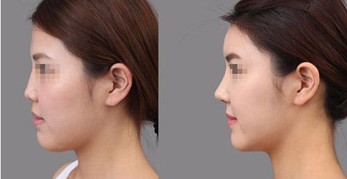 鄭州割雙眼皮醫(yī)院排名榜單揭曉，東方、華山等機構(gòu)躋身前十強！