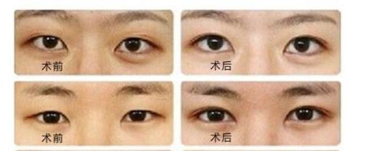 菲塑美減肥針：效果評估、價格和潛在風險全解析