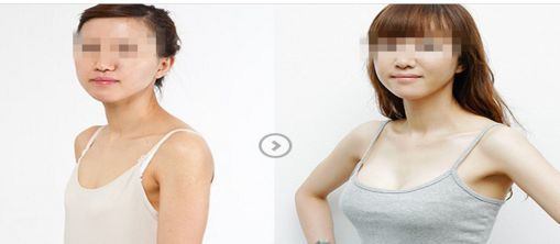 北京童仁醫(yī)院專家團(tuán)隊(duì)介紹及雙眼皮手術(shù)恢復(fù)過(guò)程詳解