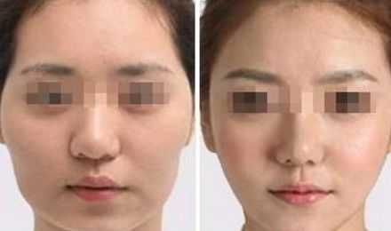 揭秘北京東方和諧脂肪填充真容，真實案例展示精湛技藝！