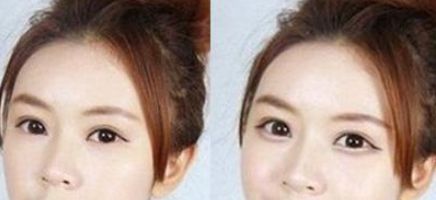 注射伊維蘭隆鼻，多久恢復消腫效果好？