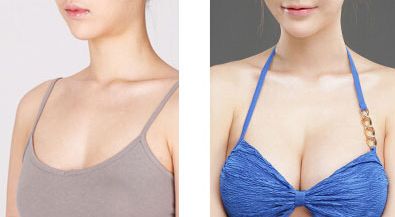 大連李爽矯治專家：隱形矯治、金屬托槽哪家好！