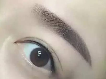 蘇州圣愛醫(yī)院整形科：90天變化揭示，雙眼皮驚喜盡顯！