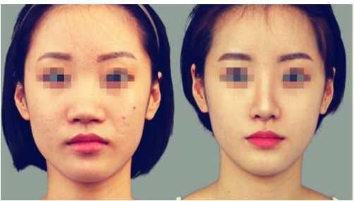 李保鍇鼻修復(fù)口碑調(diào)查 修復(fù)實(shí)例分享