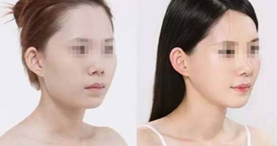 石家莊哪家整形醫(yī)院在隆鼻方面有口碑？