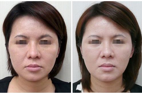 吉大一院皮膚科光子嫩膚效果怎么樣？專家團(tuán)隊(duì)解析祛斑案例