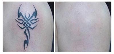 山西省整形外科醫(yī)院劉晉元好不好？割雙眼皮有何特色，值得信賴嗎？