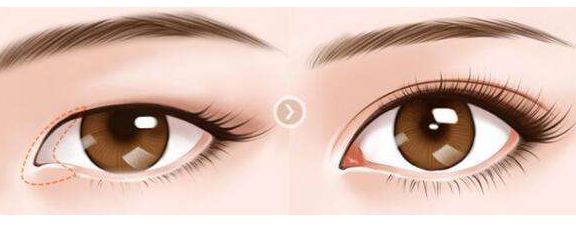 肖海濤的雙眼皮割成效如何？獨(dú)特技術(shù)吸引圈粉！