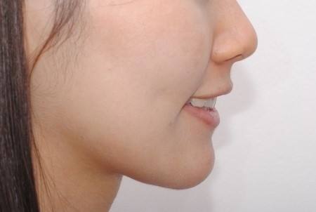 溫醫(yī)大附二院整形科鼻綜合修復(fù)效果可信賴嗎？徐海艇醫(yī)生的豐富經(jīng)驗(yàn)是否值得信賴呢？