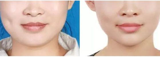 吉林梁一國醫(yī)生為您呈現(xiàn)神奇雙眼皮手術(shù)！2023親身經(jīng)歷分享