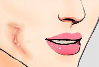 三亞心夢(mèng)醫(yī)學(xué)劉濤醫(yī)生揭秘，無(wú)創(chuàng)吸脂實(shí)踐案例分享及收費(fèi)解析！