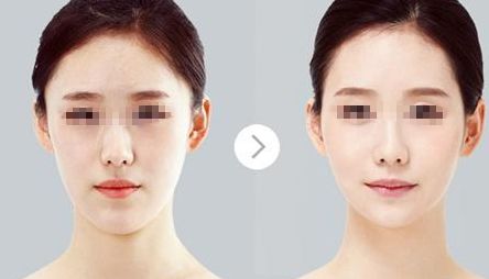 鄭州哪家醫(yī)院比較好做唇部整形？