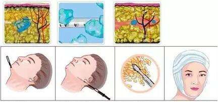 哈爾濱醫(yī)科大學(xué)附屬一院植發(fā)價(jià)格查詢及專家預(yù)約攻略