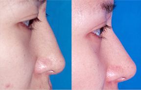 莆田黃金射頻微針去妊娠紋：2023年醫(yī)院排行榜全新公開，這家醫(yī)院專業(yè)正規(guī)！