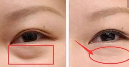 上海楊亞益雙眼皮修復(fù)技術(shù)解析，案例分享全文解讀