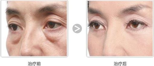 長沙哪家醫(yī)院做隆胸好？專家推薦！