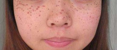 深度解析廣東萊美醫(yī)療美容醫(yī)院吸脂技術(shù)優(yōu)劣，費(fèi)用詳細(xì)解讀