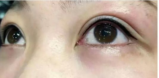 全面評(píng)估2023年全國(guó)雙眼皮手術(shù)醫(yī)生實(shí)力大揭秘