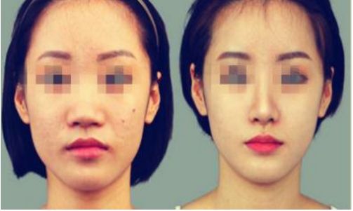 贛州哪家醫(yī)院的鼻部整形好？