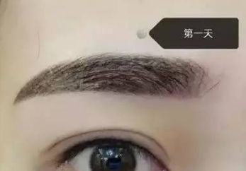 馮斌自體脂肪豐胸效果如何？案例分享給您