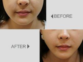 上海九院鼻部整形權(quán)威醫(yī)生曝光，李青峰、章一新上榜！