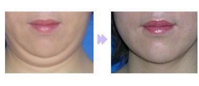 成都友誼醫(yī)院整形科優(yōu)秀醫(yī)師推薦：全臉脂肪填充效果如何？