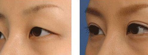 上海九院凸嘴手術費用高昂？手術技術如何？推薦醫(yī)生參考