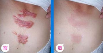 九院脂肪填充，醫(yī)生技術(shù)高超，詳細(xì)價(jià)格表揭曉