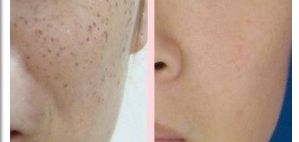 郭金冉面部填充成本公開！醫(yī)生個(gè)人技術(shù)評(píng)價(jià)曝光！在線案例展示！