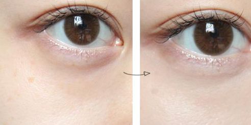 德陽王亞國雙眼皮修復(fù)90天體驗(yàn)細(xì)節(jié)圖分享