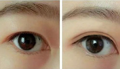 揭秘楊曉楠的獨特魅力，驚艷雙眼皮成果展示，超值一覽價格！