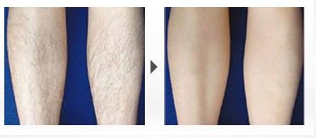 脂肪豐額頭手術的效果如何？了解專家的分享