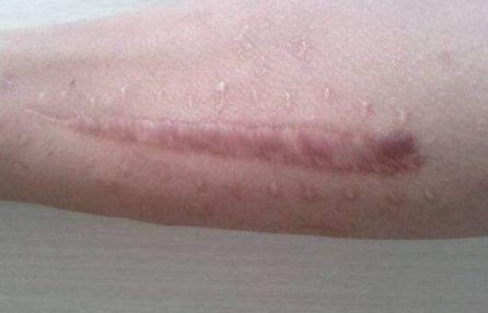 北京藝星白書白師傅，2023獨家案例揭秘：雙眼皮手術讓你閃耀美麗！