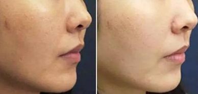 八大處王佳琦醫(yī)生獨(dú)家技術(shù)！驚艷去眼袋，50天展示成果震撼！